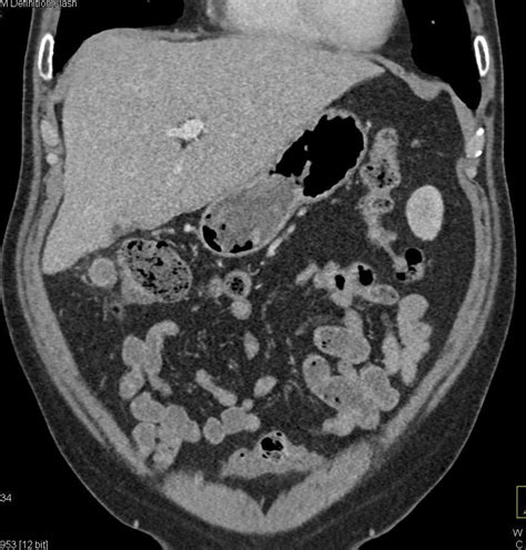 Esophageal Cancer With Supraclavicular And Abdominal Adenopathy