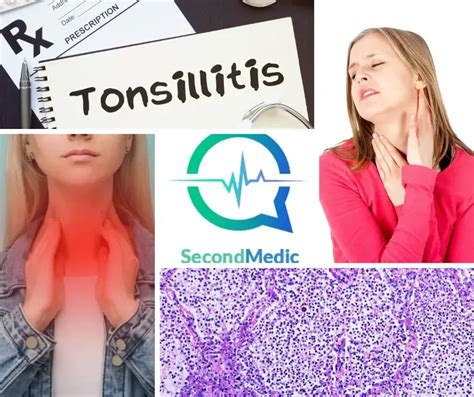 Tonsillitis Causes Symptoms Diagnosis Treatment