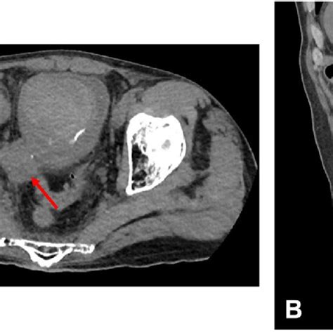 Ct Abdomen Pelvis Without Iv Contrast Showing A Urinary Bladder Mass