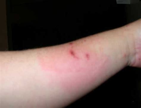 Blog About Cats Picture Of Cat Scratch Fever