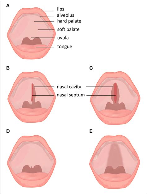 Subtypes And Subclinical Forms Of Cleft Palate A Normal Lip And