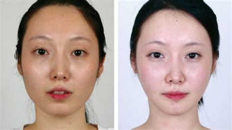 What Are The Benefits Of Non Surgical Jaw Reduction Treatments My