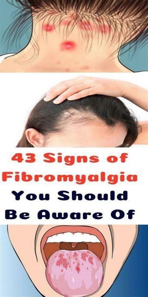 43 Signs Of Fibromyalgia You Should Be Aware Of In 2020 Signs Of