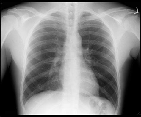 The Chest X Ray In Cardiovascular Disease Wikidoc