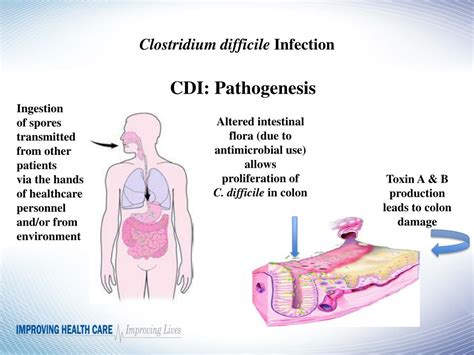 Ppt Clostridium Difficile Infection Powerpoint Presentation Free