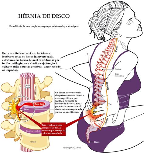 Dor Na Ultima Vertebra Da Coluna