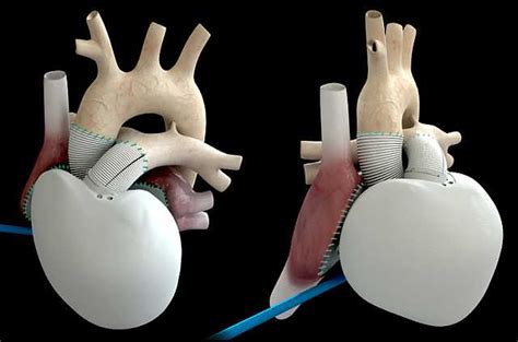 Primer Corazón Artificial Implantado