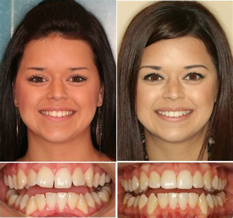 Invisalign Before And After Overcrowding Before And After