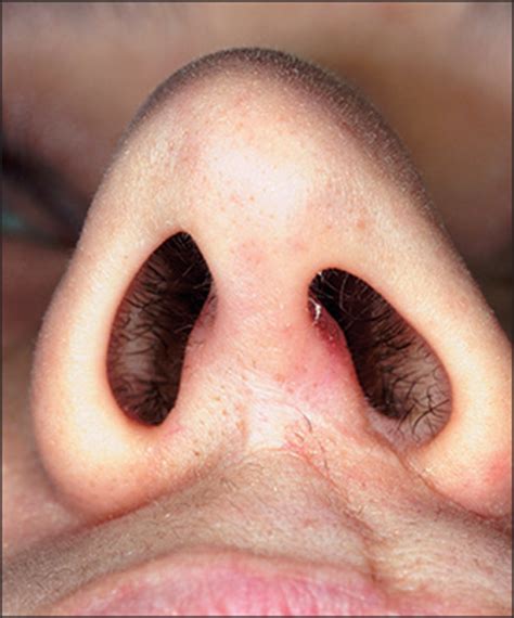 Septoplasty For Nasal Obstruction The Lancet
