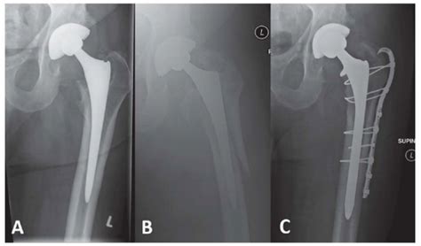 Fixation Of Periprosthetic Fractures Aboutbelow Total Hip Arthroplasty