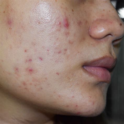 Post Inflammatory Erythema Pie Treating After Acne Red Spots Slmd