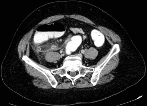 Appendicitis On Ct Radrounds Radiology Network