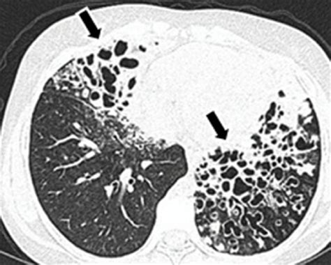 Cystic Bronchiectasis In A 12 Year Old Girl Hrct Shows Bilateral