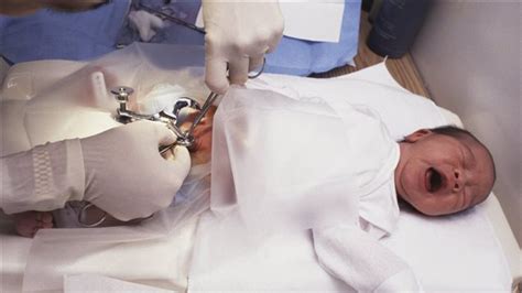 Canadian Paediatricians Modify Position On Circumcision RCI English
