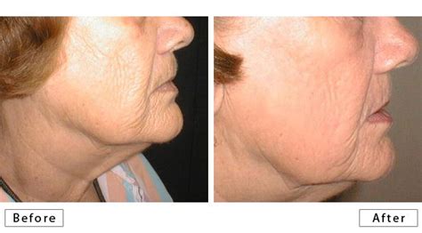 New Orleans Skin Doctor Rose Dermatology Laser Skin Resurfacing