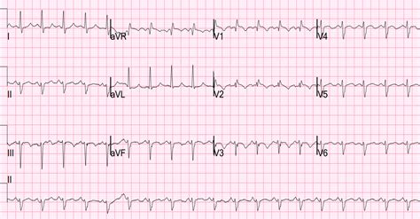 Right axis deviation — (rad) see axis d … medical dictionary. Dr. Smith's ECG Blog: Dyspnea on Exertion and a Positive ...