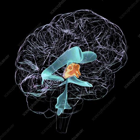 Enlarged Third Ventricle Of The Brain Illustration Stock Image