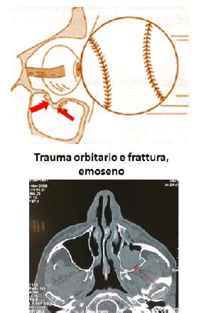 Le fratture del massiccio facciale, orbitarie, zigomatiche ...