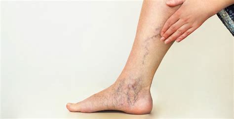 The Difference Between Arterial And Venous Disorders In Your Legs
