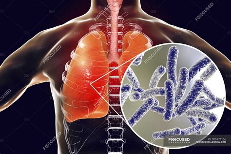 Lungs With Legionnaires Disease And Close Up Of Legionella Pneumophila