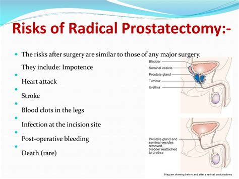 Ppt Radical Prostatectomy Surgery India Powerpoint Presentation Free Download Id