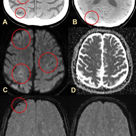 Head Computed Tomography Ct Image Taken On Day 1 Showing Multiple