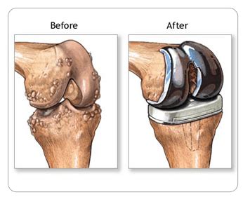 Dr. Nishikant Kumar | Orthopaedics and joint replacement surgeon | Total Hip Replacement | Knee ...