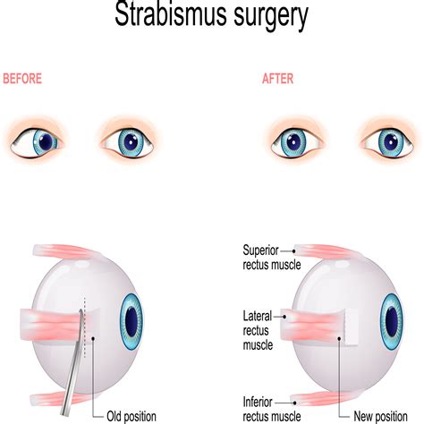 Strabismus Surgery What To Expect And Faq Vision Center
