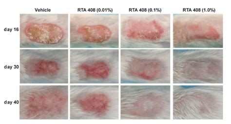 New Study Tests Lotion To Treat Radiation Dermatitis In Breast Cancer