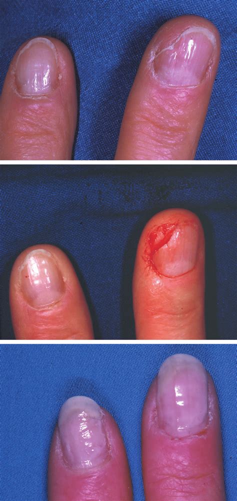 Above Partial Fingernail Defect After Trauma Center Excision Of