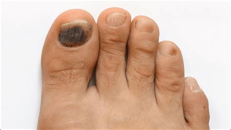 Risks Of Diabetic Black Toenail Discoloration Black Toenail Fungus Black Toe Nails Toenail