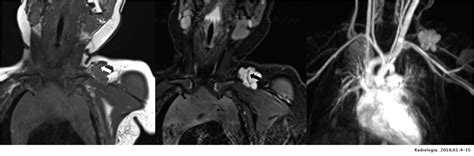 Soft Tissue Vascular Malformations And Tumors Part 1 Classification