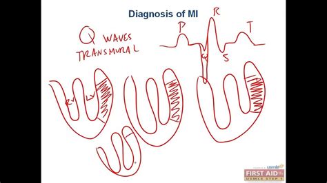 Diagnose of MI based on Cardiac marker's CVS pathology video part 14