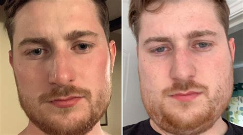 Mumps Symptoms Explained As Cases Surge In England Huffpost Uk Life