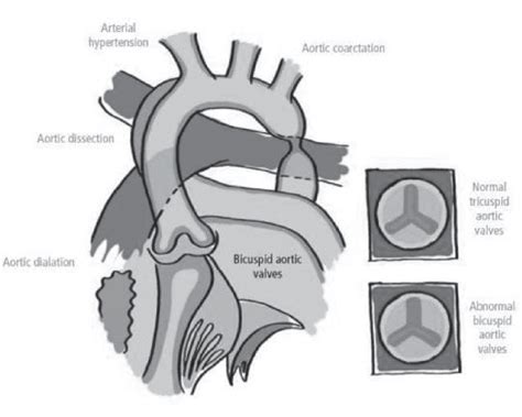 The Figure Illustrates The Occurrence Of Bicuspid Aortic Valves Aortic