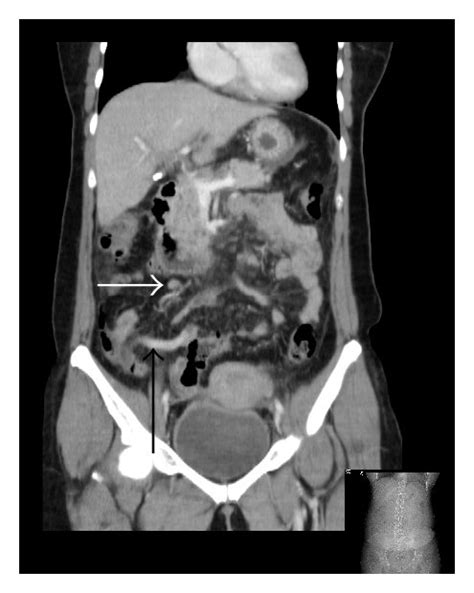 A Axial Ct With Intravenous Contrast The Appendix Is Seen Anterior