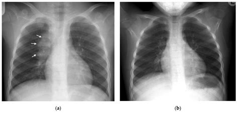 Pathogens Free Full Text Chest Imaging For Pulmonary Tb—an Update
