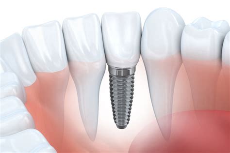 Dental Implant Faq • Charleston Wv • Mountain State Oral And Facial