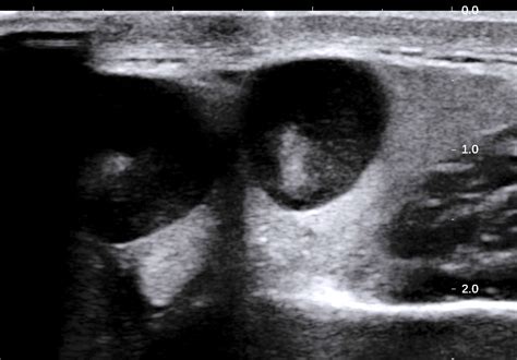 Vietnamese Medic Ultrasound Case T Cell Lymphoma Of Submandibular