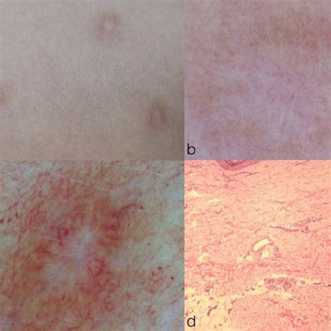 Frequency Of Dermoscopic Variables In Psoriatic Lesions Located On