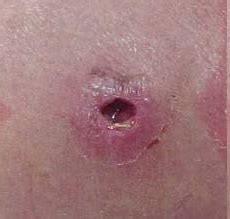 Mrsa infections mainly affect people who are staying in hospital. MRSA Infection Clearly Explained