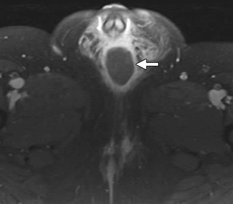 Mr Imaging Of The Penis And Scrotum Radiographics