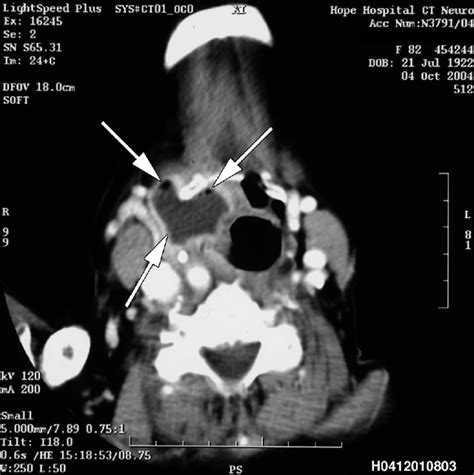 Ct Scan Image Showing A Large Mixed Right Sided Laryngocele Opening
