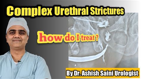 Complex Urethral Stricture How Do I Treat Them Live Surgery Youtube