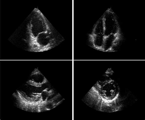 Four Different Ultrasound Views Of The Heart Clockwise From Upper