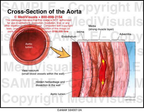 Aortic Dissection Longitudinal And Cross Section Of Blood Vessel The Best Porn Website