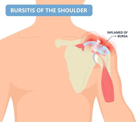Shoulder Bursitis Causes Symptoms Treatment Hot Sex Picture