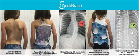 Intense Scoliosis Therapy Edina Mn Scoliosis Specialist And Pain Therapy