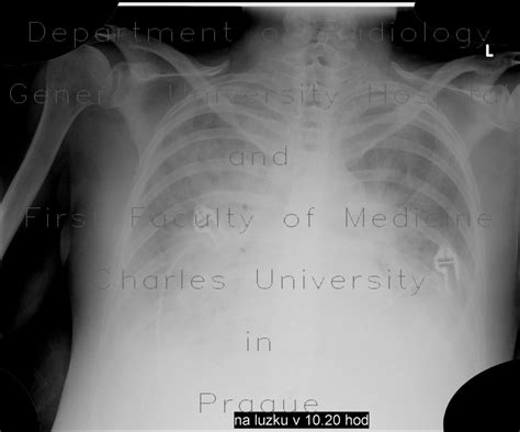 Radiology Case Alveolar Pulmonary Edema