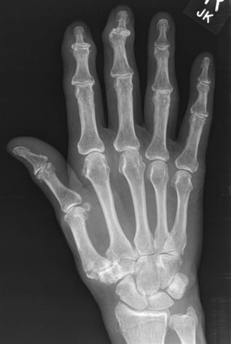 Hand Osteoarthritis — Clinical Presentation Phenotypes And Management